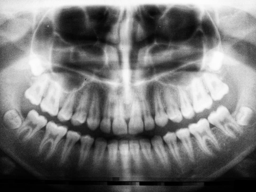 Panoramic dental X-ray showing a full set of teeth